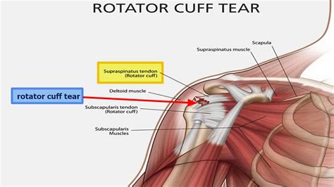 Rotator cuff tear symptoms, causes, diagnosis, prognosis and treatment