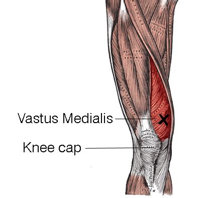 Vastus Lateralis Pain