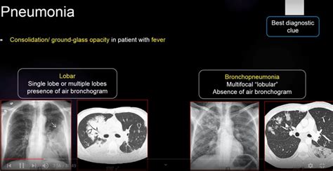 Bronchopneumonia Vs Lobar Pneumonia