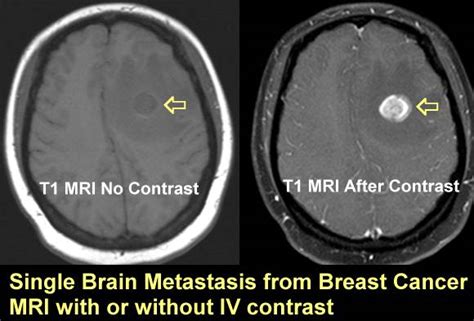 MRI Images of Brain Mets