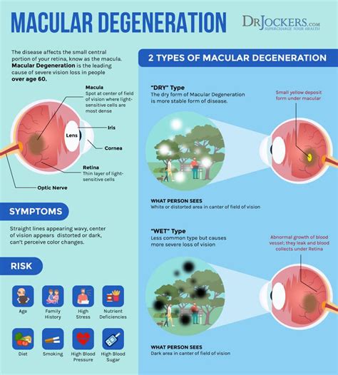 Macular degeneration causes symptoms natural support strategies – Artofit