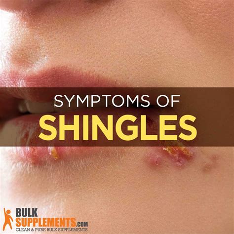 Can Shingles Start On Your Lips | Lipstutorial.org