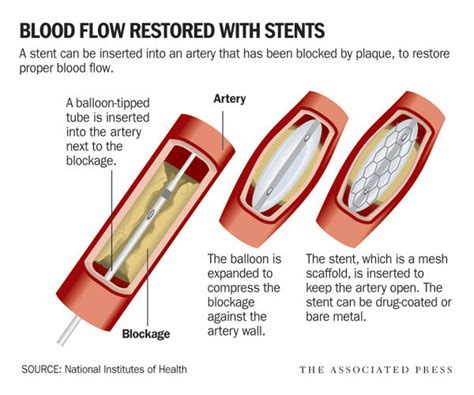 Why do leg stents fail so fast? UNMC has a $3.5 million grant to find ...