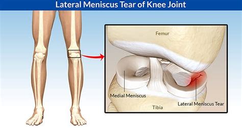 Lateral Meniscus Tear: Symptoms, Diagnosis and Treatment | New Health ...