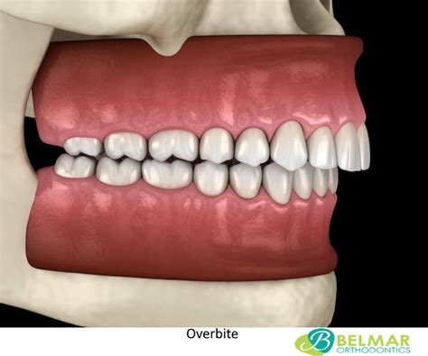 Overbite Teeth: What is an overbite or Buck Teeth?, Treatment, Causes ...