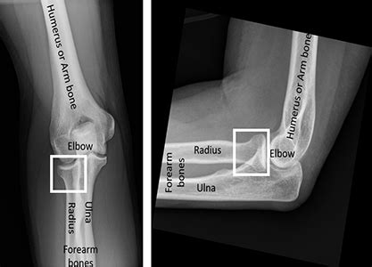 Fracture radiale de la tête | Aranjuez