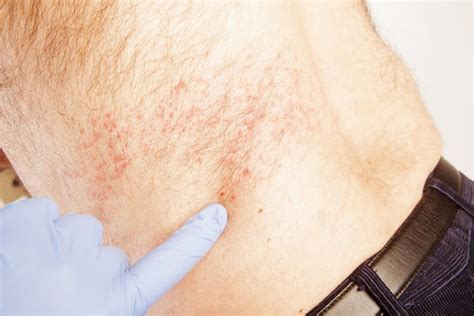 Shingles Skin Rashes