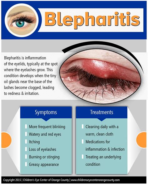 Blepharitis - Dr. Golareh Fazilat, MD | Eye care health, Eye facts ...