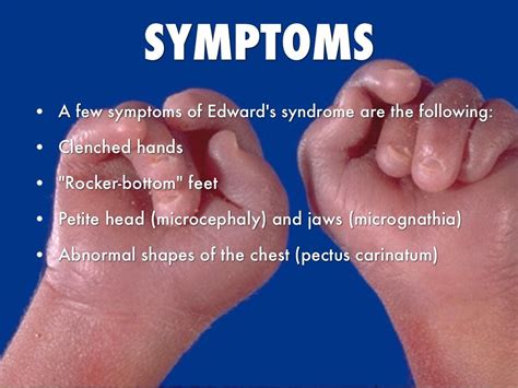 what is the life expectancy of someone with edwards syndrome - Wilton ...