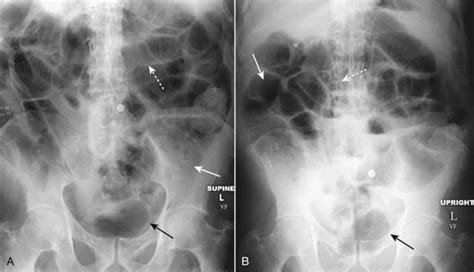 Recognizing Bowel Obstruction and Ileus | Radiology Key