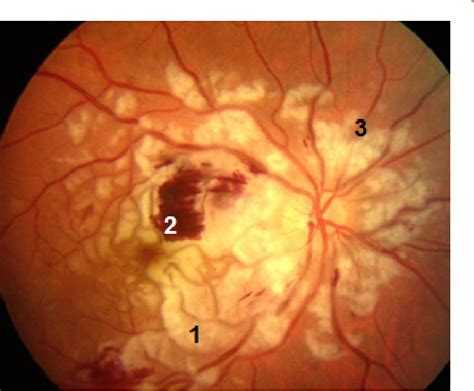 Figure 1 from Purtscher and Purtscher-Like Retinopathies: What Do We ...