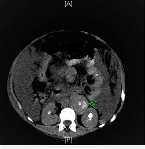 CT scan of the abdomen with the enlarged retroperitoneal lymph nodes ...