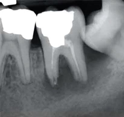 Mandibular left second molar with symptomatic apical periodontitis. (a ...