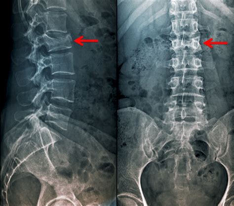 [경기광주 재활PT] 허리 X-ray 보는 방법 및 꿀팁!! ( 다른 부분을 볼 때도 마찬가지입니다 ) : 네이버 블로그