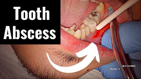 INCSSION AND DRAINAGE OF DENTAL ABSCESS - Dental Clinic