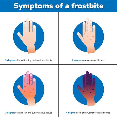 Simptoms of a frostbite 4 medical stages Infographic 2396603 Vector Art ...