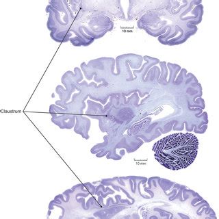 Claustrum location in human brain. Coronal (top), sagittal (middle ...