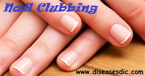 Nail Clubbing – Causes, Symptoms, and Treatment.