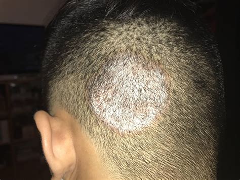 Fungal infection on Scalp? Ringworm? Psoriasis? (x-post r/Dermatology ...