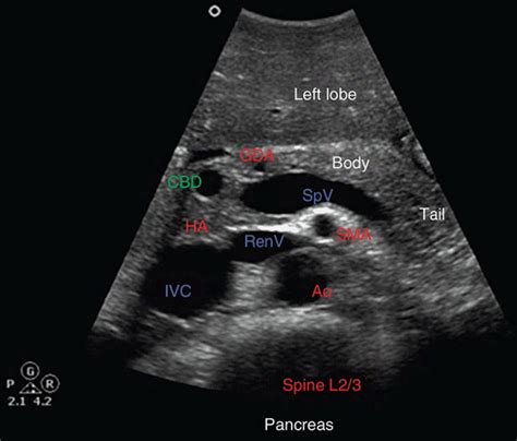 Ultrasound of the Pancreas | Radiology Key