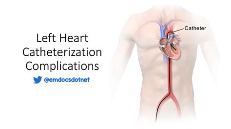 emDOCs.net – Emergency Medicine EducationLeft Heart Catheterization ...