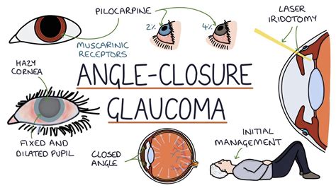 Understanding Acute Angle Closure Glaucoma - vTomb