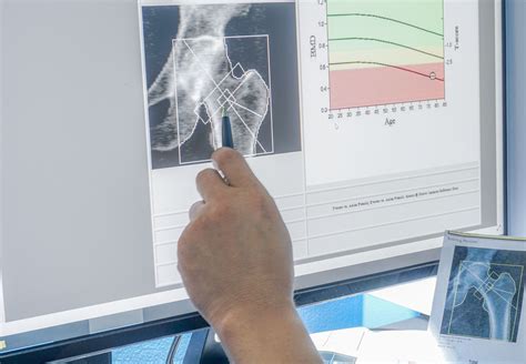 Osteoporosis Diagnosis: Screening, Testing, & More