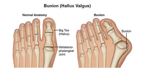 Bunions - Advance Foot Clinic Podiatry