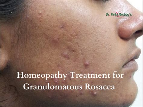 Homeopathy Treatment for Granulomatous Rosacea