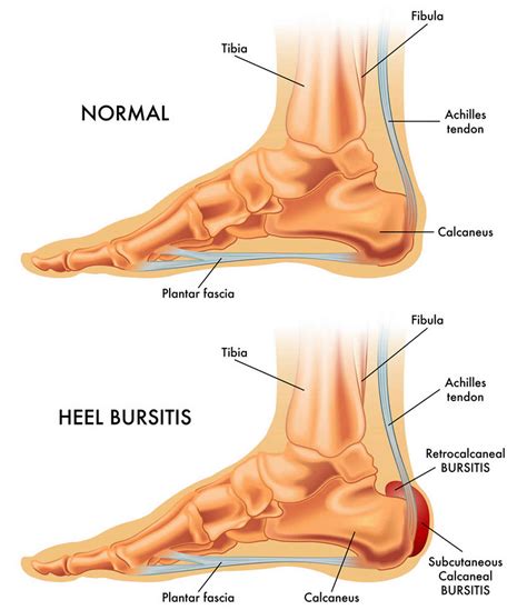 Retrocalcaneal bursitis causes, symptoms, diagnosis & treatment