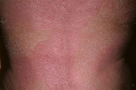 Erythrodermic psoriasis pictures | Symptoms and pictures