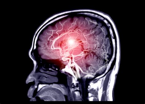 What Is A Brain Aneurysm? And What Are The Causes, Symptoms, and ...