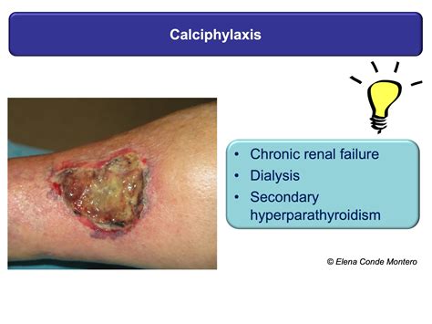 Leg Ulcer Wound Care