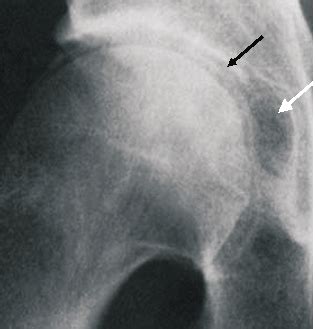 Hip Bone Cyst