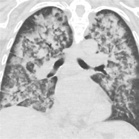 A 63-year old man with diffuse alveolar hemorrhage due to heart failure ...