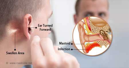 Mastoiditis Symptoms