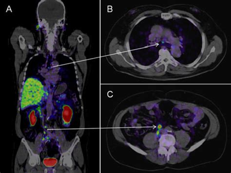 Does a PET scan show all cancers?