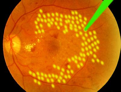 DIABETIC RETINOPATHY | Presbit