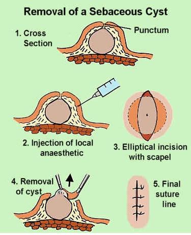 Sebaceous Cyst (Epidermal Cyst) - Pictures, Causes, Treatment and Removal