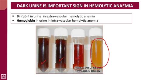 Hematology - 2 | U1-L5 | Why dark urine is an important sign in HA ...