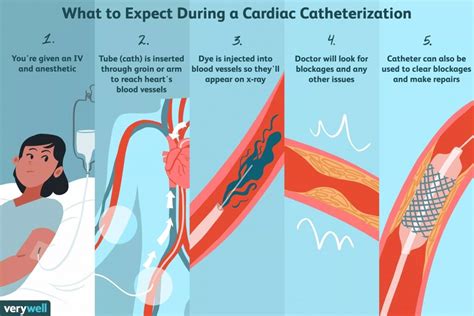 What to expect during Cardiac Catheterization - THW Cardiology Center ...