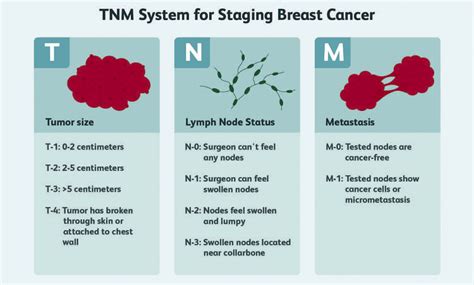 Understanding the stages of breast cancer | Jones County News