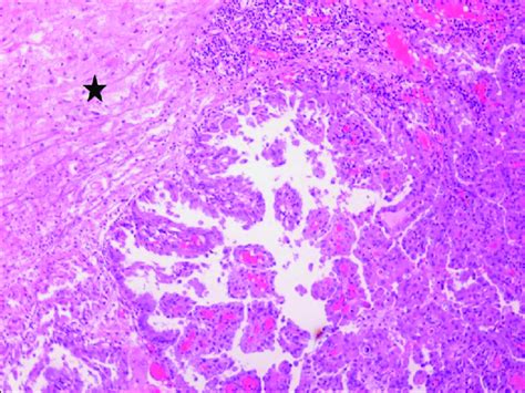 Metastasis of thyroid papillary carcinoma in the brain. Asterisk on the ...