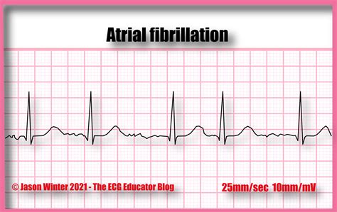 ECG Educator Blog : Atrial Fibrillation (AF)