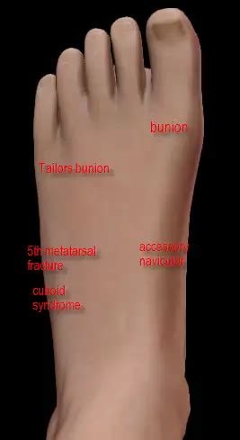 SIDE OF FOOT PAIN- Symptoms, Diagnosis, Treatment, Prevention