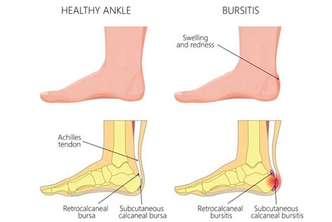 Achilles Bursitis Retrocalcaneal Bursitis Symptoms, Causes Treatment ...