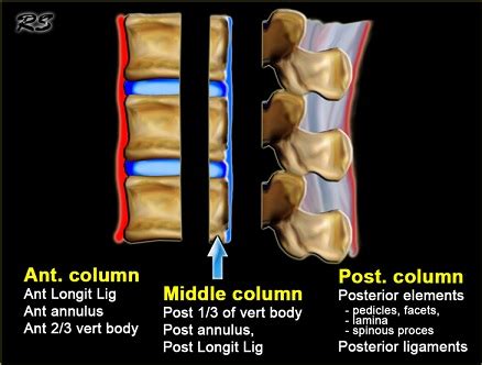 Lumbar Spine Fracture - Physiopedia