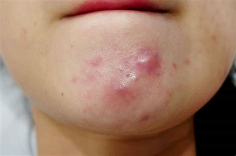 Cystic Acne Causes & Best Treatment To Get Rid of Cystic Acne On Chin