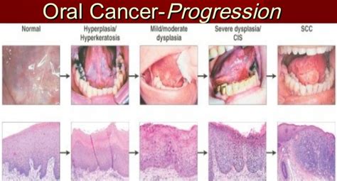 The Warning Signs & Symptoms of Mouth Cancer — Emergency Dentist ...