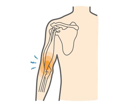 Biceps Tendonitis - Motus Physical Therapy